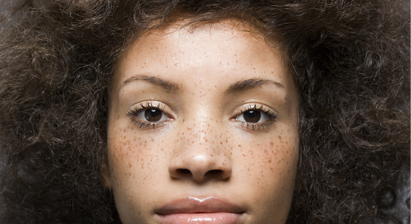 Freckle Treatments in Korea: How Korean Clinics Fade Spots, Not Skin Identity