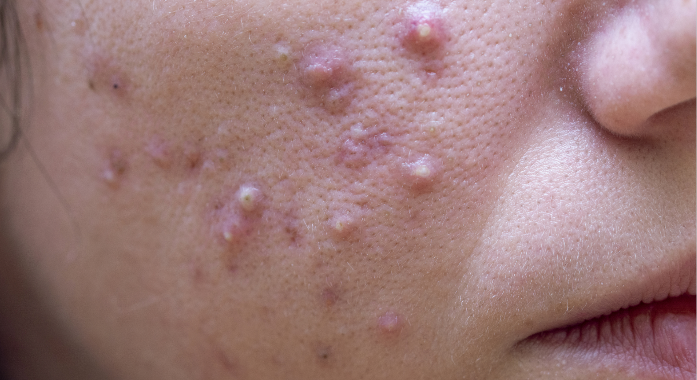 Scar Treatment in Korean Dermatology: How to Fade Acne Marks, Surgery Scars & Trauma