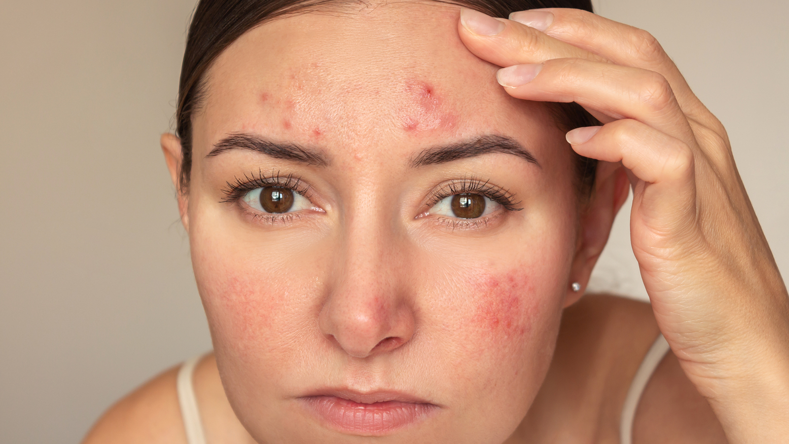 How Korean Dermatologists Treat Acne Scars: RF Microneedling, Fraxel & Combination Care