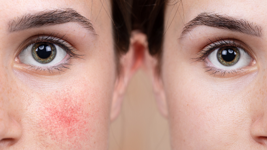 Korean Redness Treatments: How Dermatologists Calm Sensitive Skin