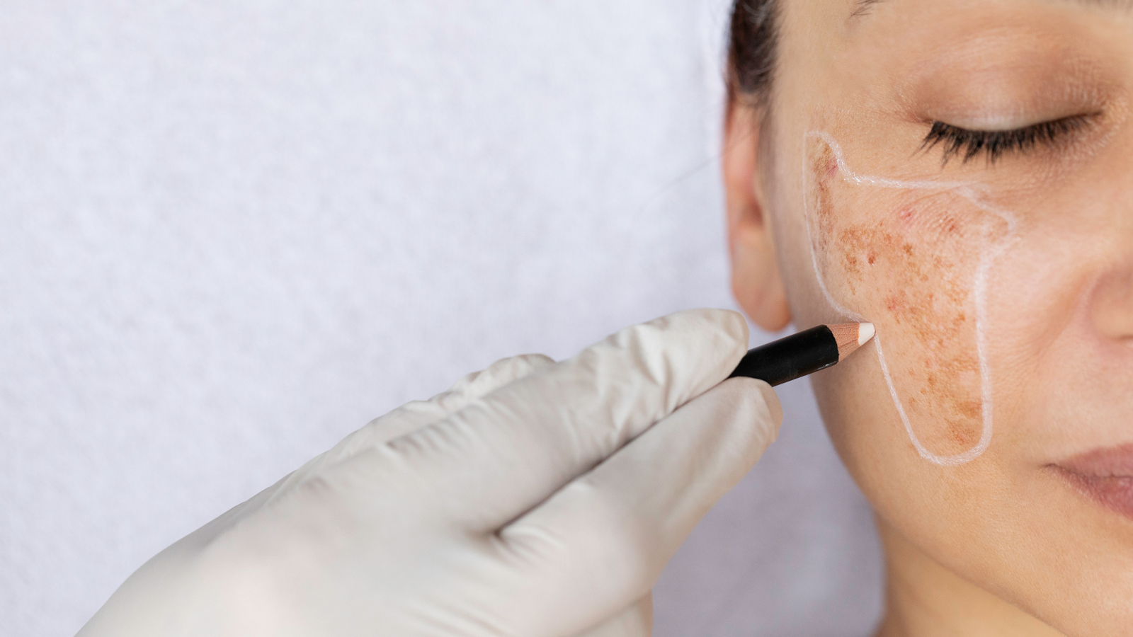 Dark Spots and Melasma: Why the Diagnosis Decides the Treatment