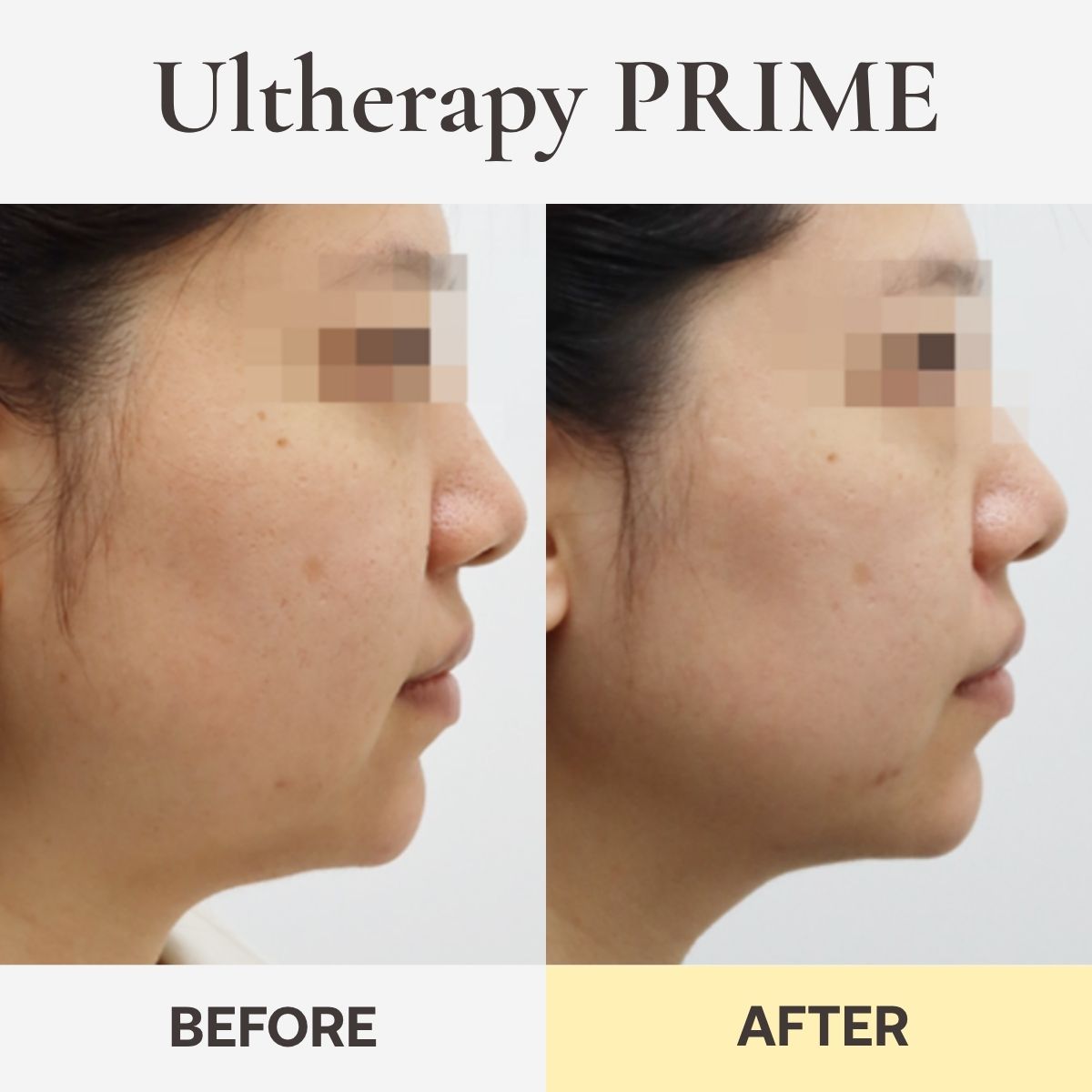 Ultherapy PRIME before and after, side profile, at CHAI Clinic